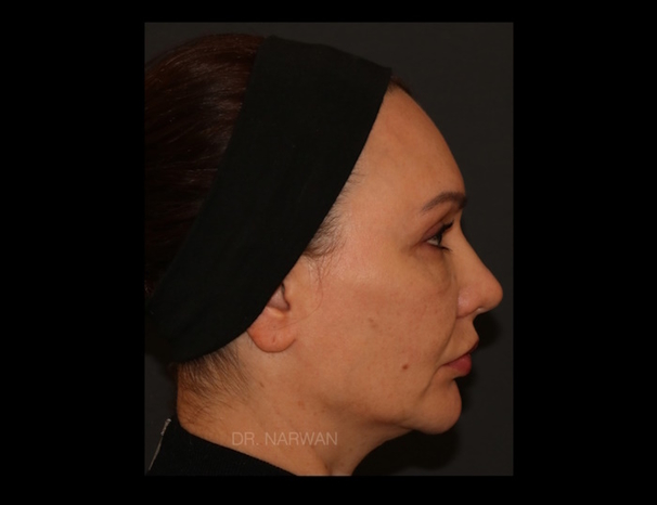 treatment-full-face-04-dr-narwan-plastic-aesthetic-surgeon-dubai.jpg 
