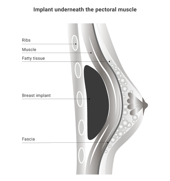 Illustration breast surgery, Dr. Narwan, Plastic and Aesthetic Surgery Dubai