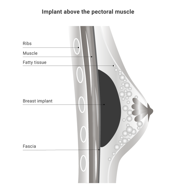 Illustration breast surgery, Dr. Narwan, Plastic and Aesthetic Surgery Dubai