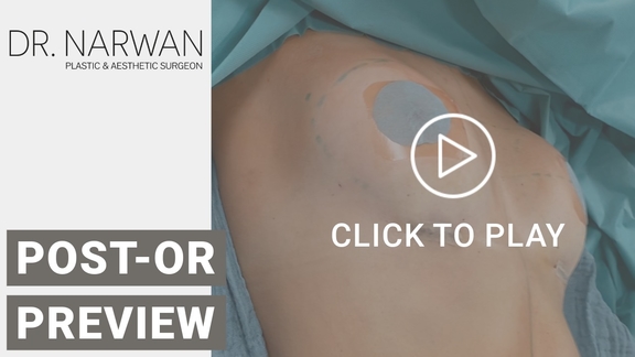 Thumbnail Video Breast Surgery Result, Dr. Narwan, Plastic and Aesthetic Surgery Dubai