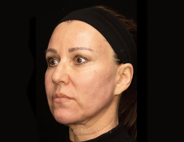 treatment-full-face-06-dr-narwan-plastic-aesthetic-surgeon-dubai.jpg 