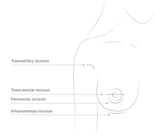 Illustration breast surgery, Dr. Narwan, Plastic and Aesthetic Surgery Dubai